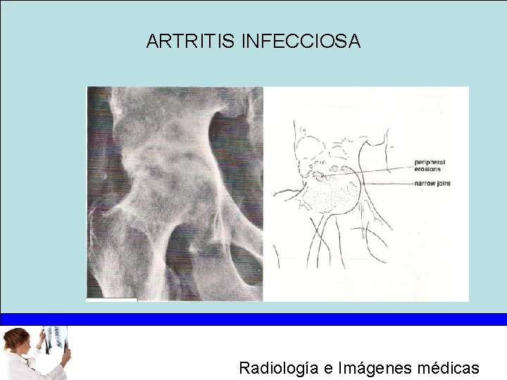 ARTRITIS INFECCIOSA Radiología e Imágenes médicas 