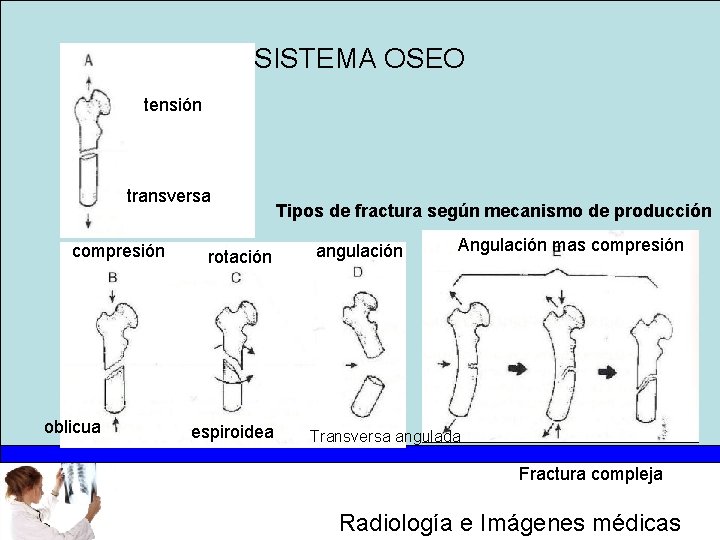 SISTEMA OSEO tensión transversa compresión oblicua rotación espiroidea Tipos de fractura según mecanismo de