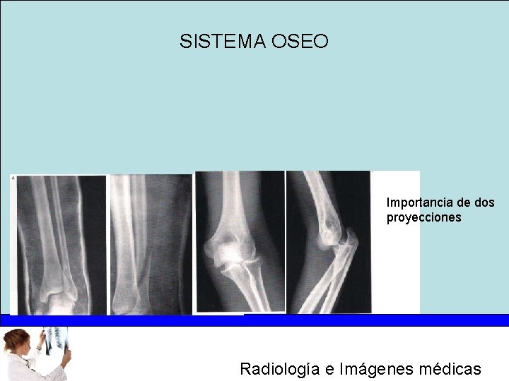 SISTEMA OSEO Importancia de dos proyecciones Radiología e Imágenes médicas 