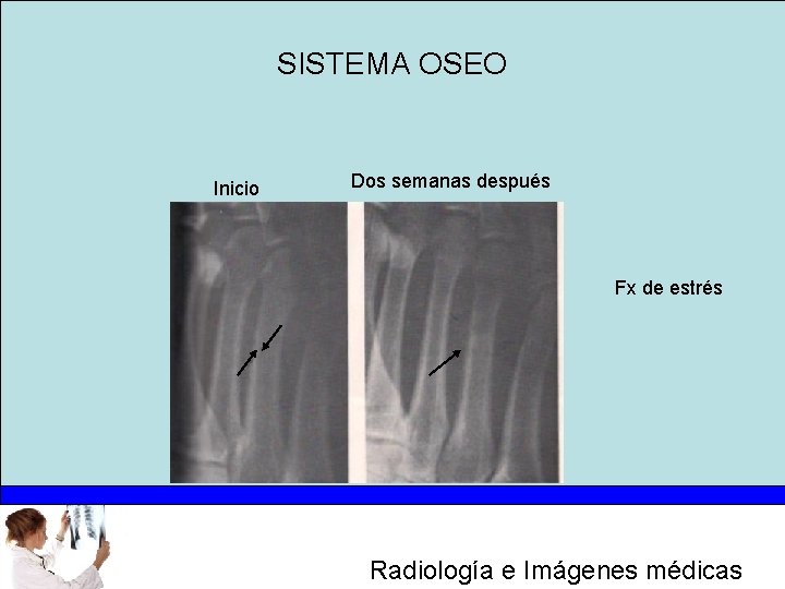 SISTEMA OSEO Inicio Dos semanas después Fx de estrés Radiología e Imágenes médicas 