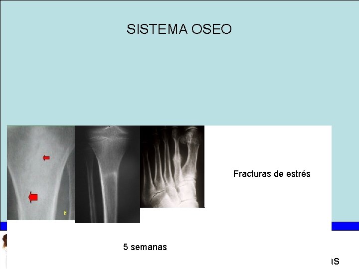 SISTEMA OSEO Fracturas de estrés 5 semanas Radiología e Imágenes médicas 