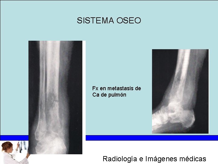 SISTEMA OSEO Fx en metastasis de Ca de pulmón Radiología e Imágenes médicas 