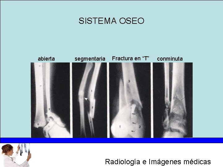 SISTEMA OSEO abierta segmentaria Fractura en “T” conminuta Radiología e Imágenes médicas 