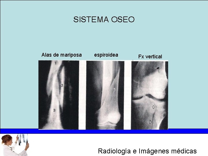 SISTEMA OSEO Alas de mariposa espiroidea Fx vertical Radiología e Imágenes médicas 