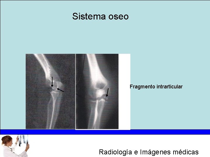 Sistema oseo Fragmento intrarticular Radiología e Imágenes médicas 