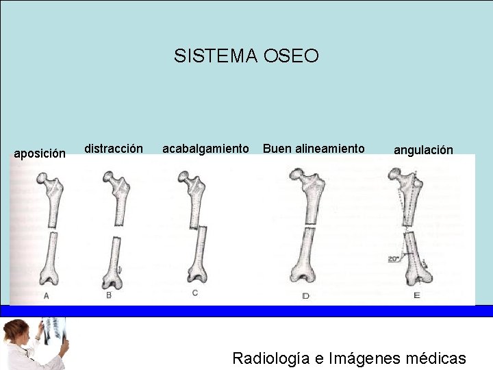 SISTEMA OSEO aposición distracción acabalgamiento Buen alineamiento angulación Radiología e Imágenes médicas 