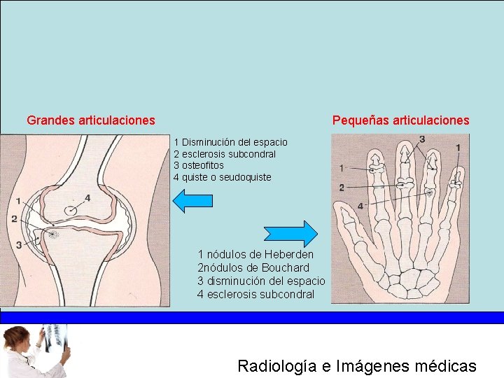 Grandes articulaciones Pequeñas articulaciones 1 Disminución del espacio 2 esclerosis subcondral 3 osteofitos 4
