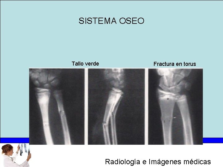 SISTEMA OSEO Tallo verde Fractura en torus Radiología e Imágenes médicas 