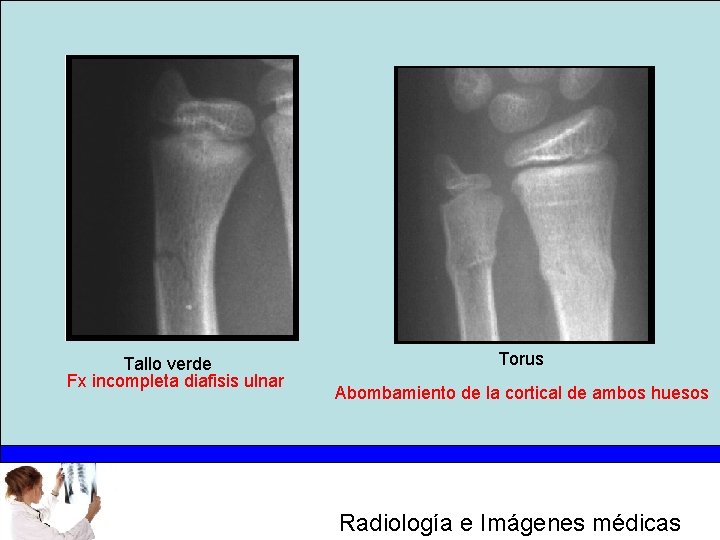 Tallo verde Fx incompleta diafisis ulnar Torus Abombamiento de la cortical de ambos huesos