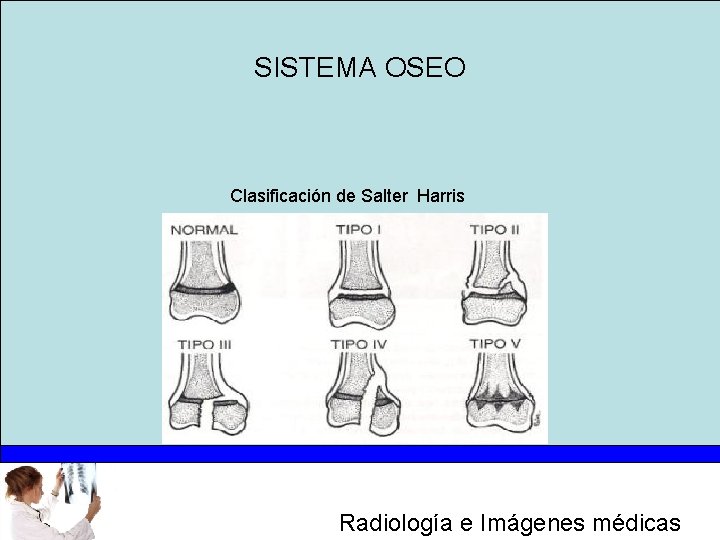 SISTEMA OSEO Clasificación de Salter Harris Radiología e Imágenes médicas 