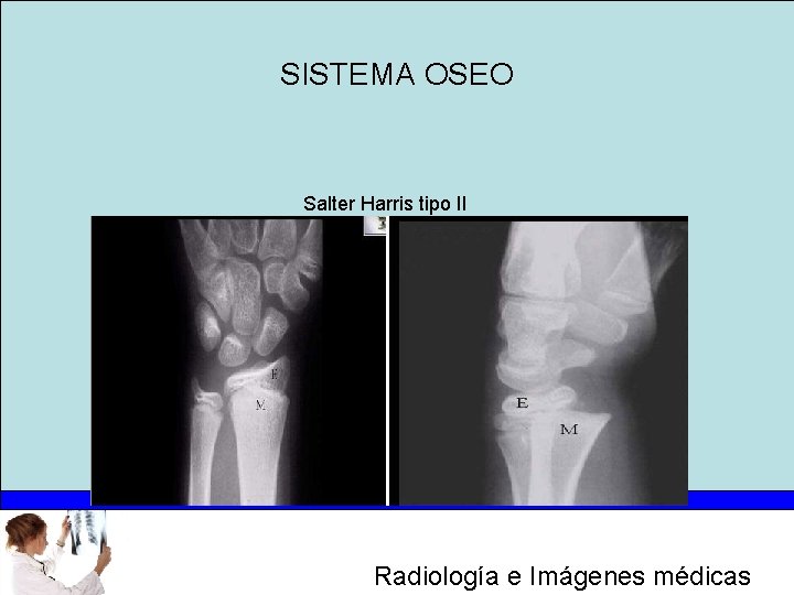 SISTEMA OSEO Salter Harris tipo II Radiología e Imágenes médicas 