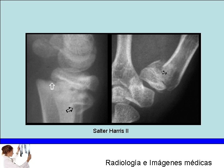 Salter Harris II Radiología e Imágenes médicas 
