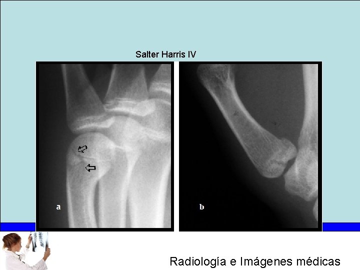 Salter Harris IV Radiología e Imágenes médicas 