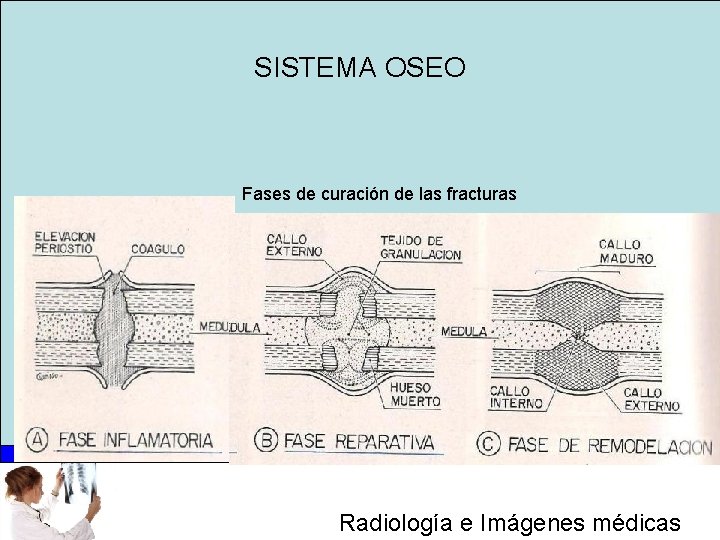 SISTEMA OSEO Fases de curación de las fracturas Radiología e Imágenes médicas 