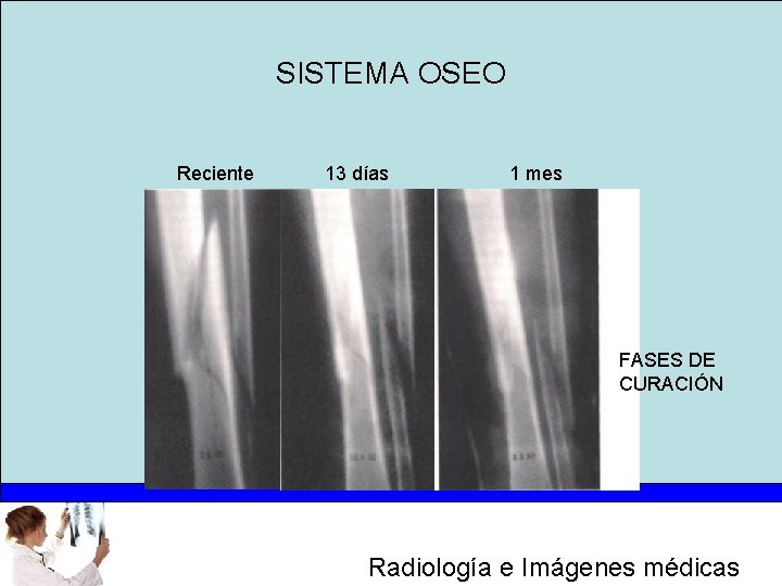 SISTEMA OSEO Reciente 13 días 1 mes FASES DE CURACIÓN Radiología e Imágenes médicas