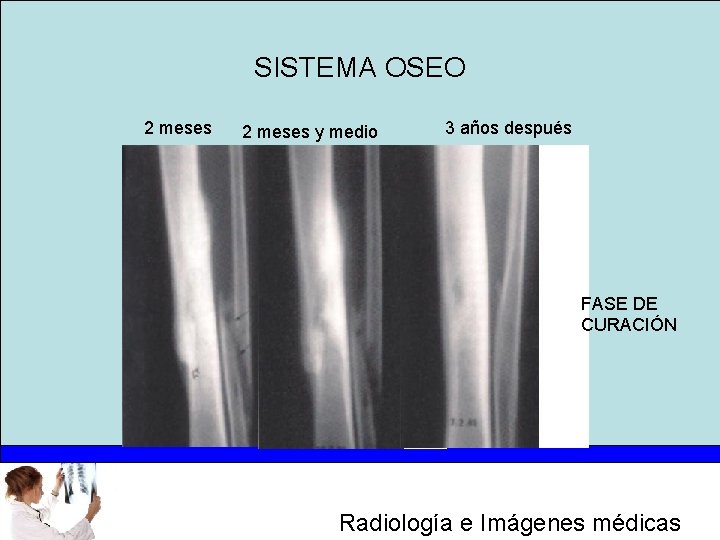 SISTEMA OSEO 2 meses y medio 3 años después FASE DE CURACIÓN Radiología e