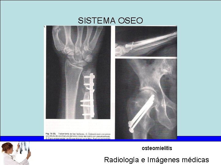 SISTEMA OSEO osteomielitis Radiología e Imágenes médicas 