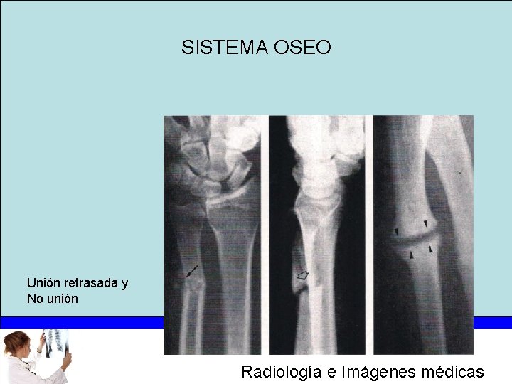 SISTEMA OSEO Unión retrasada y No unión Radiología e Imágenes médicas 