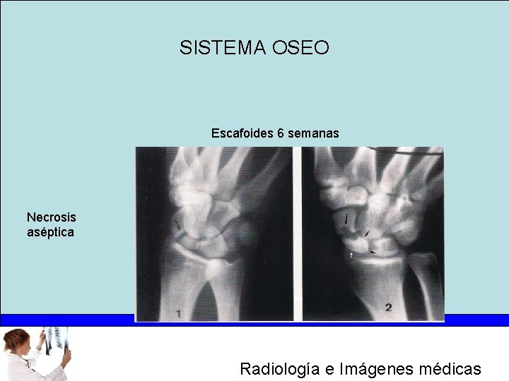 SISTEMA OSEO Escafoides 6 semanas Necrosis aséptica Radiología e Imágenes médicas 