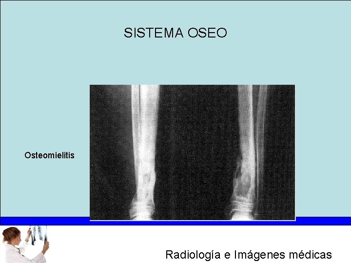 SISTEMA OSEO Osteomielitis Radiología e Imágenes médicas 