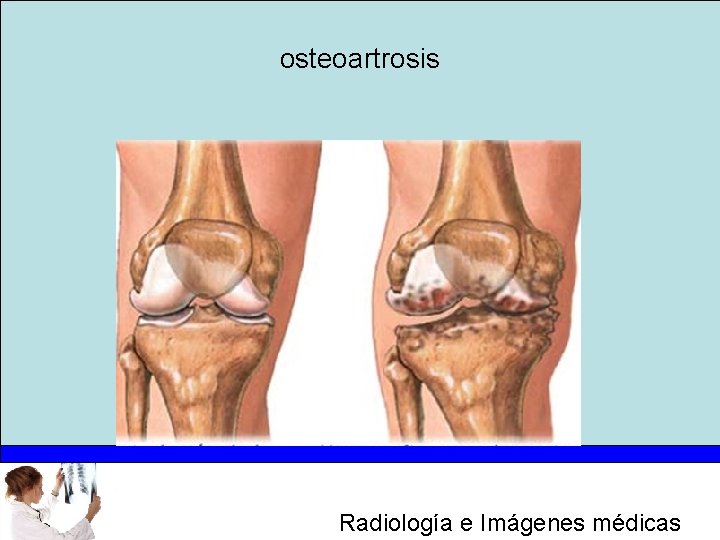 osteoartrosis Radiología e Imágenes médicas 