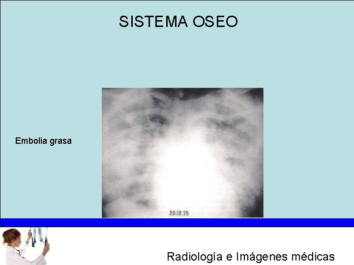 SISTEMA OSEO Embolia grasa Radiología e Imágenes médicas 