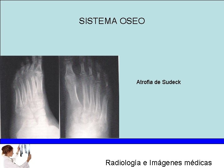 SISTEMA OSEO Atrofia de Sudeck Radiología e Imágenes médicas 