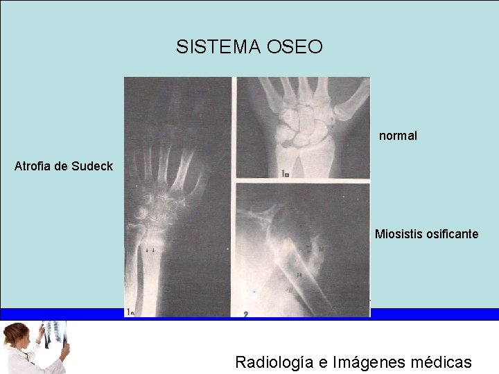 SISTEMA OSEO normal Atrofia de Sudeck Miosistis osificante Radiología e Imágenes médicas 