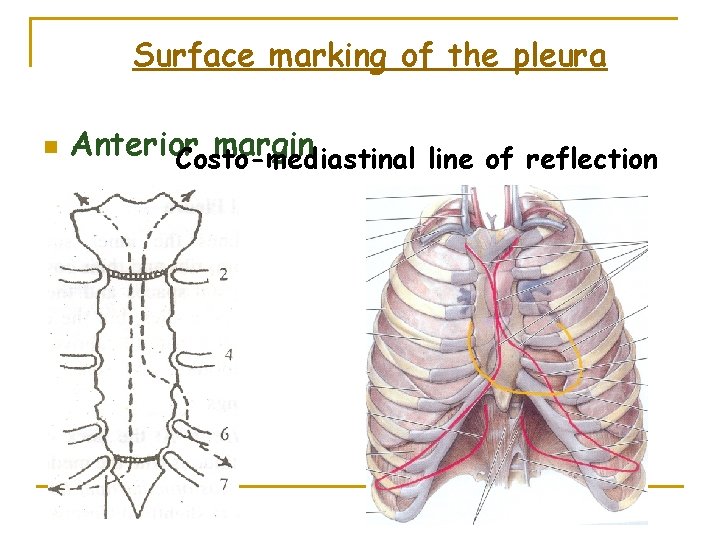 Surface marking of the pleura n Anterior margin Costo-mediastinal line of reflection 