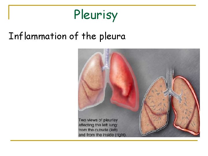 Pleurisy Inflammation of the pleura 