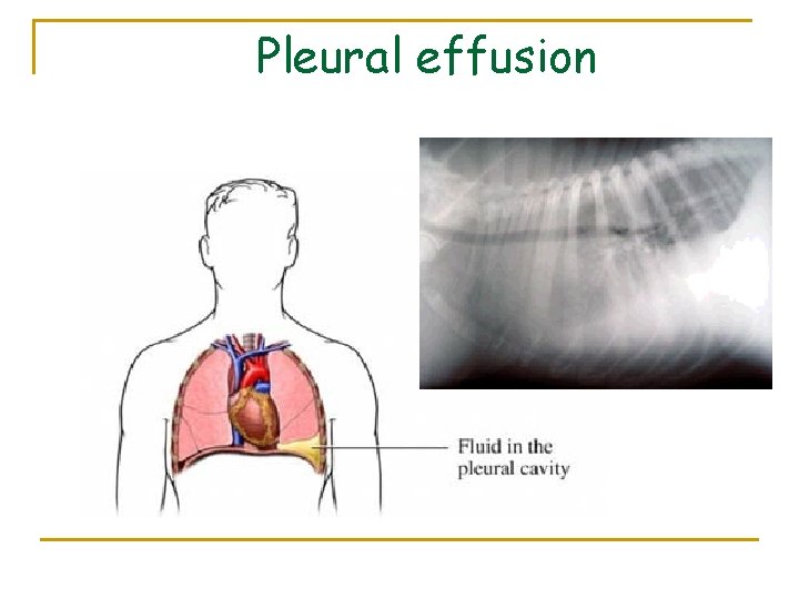 Pleural effusion 