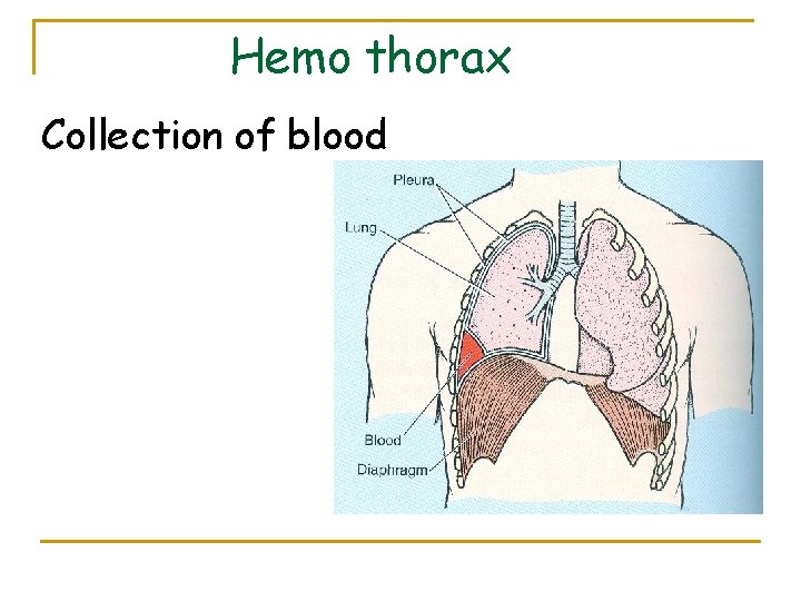 Hemo thorax Collection of blood 