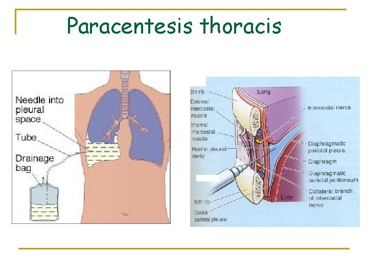 Paracentesis thoracis 