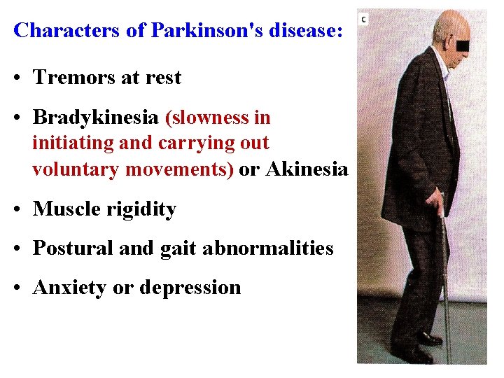 Characters of Parkinson's disease: • Tremors at rest • Bradykinesia (slowness in initiating and