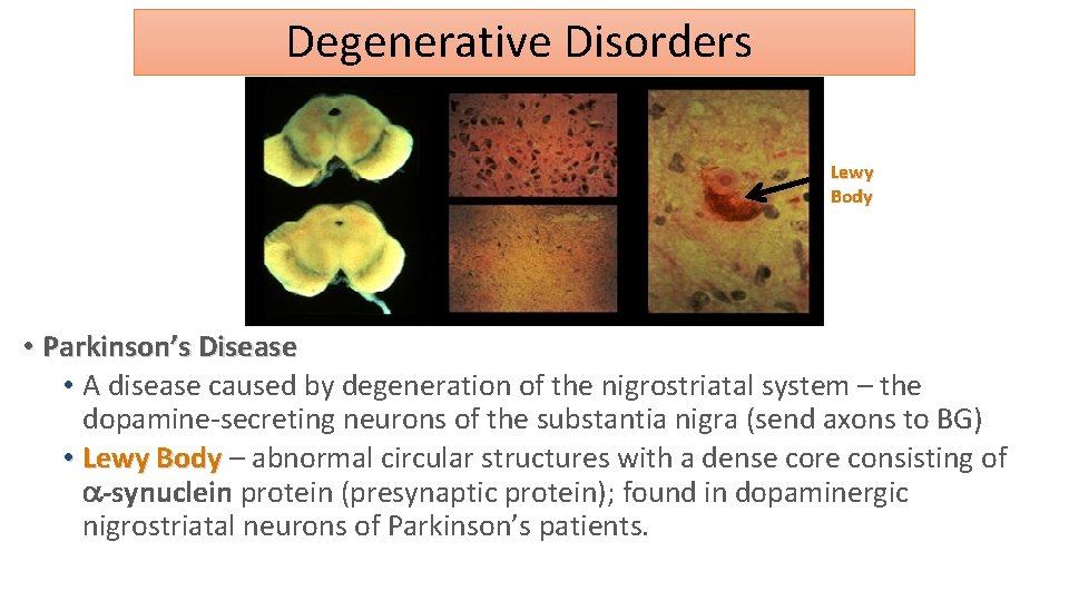  Degenerative Disorders Lewy Body • Parkinson’s Disease • A disease caused by degeneration