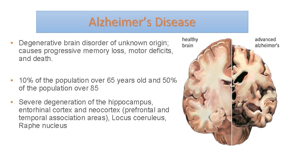 Alzheimer’s Disease • Degenerative brain disorder of unknown origin; causes progressive memory loss, motor