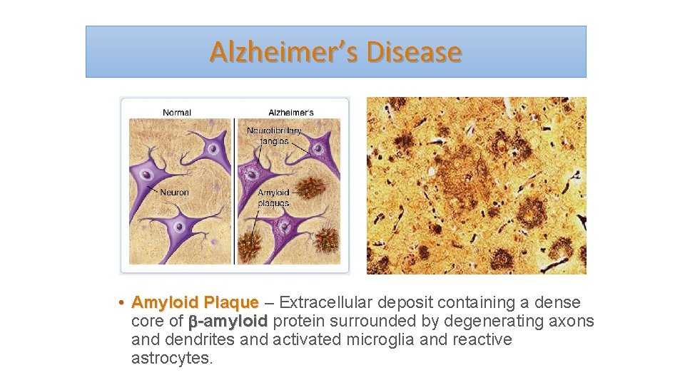 Alzheimer’s Disease • Amyloid Plaque – Extracellular deposit containing a dense core of -amyloid