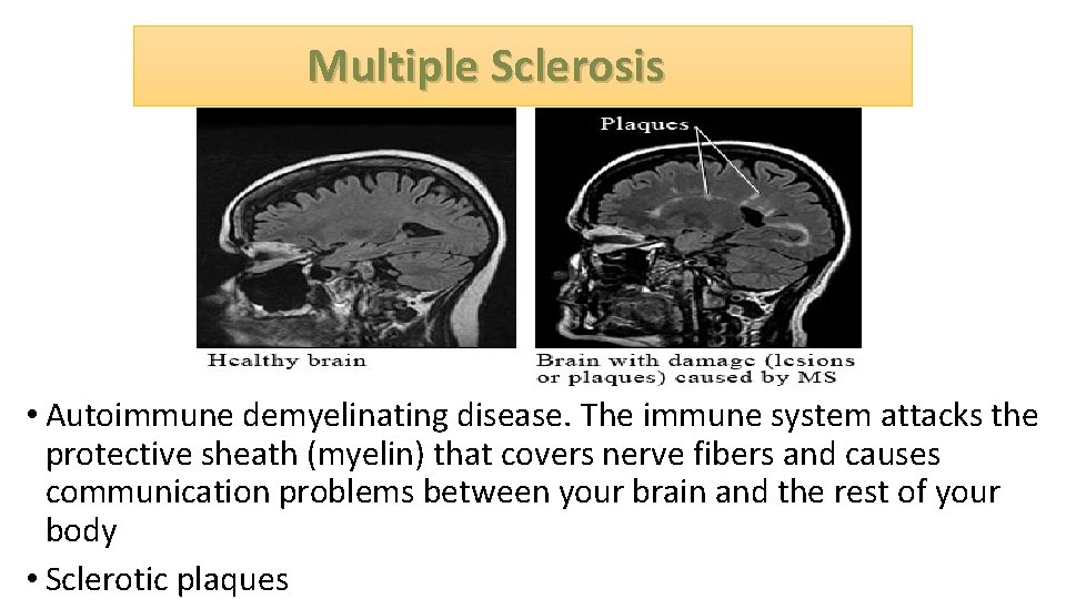  Multiple Sclerosis • Autoimmune demyelinating disease. The immune system attacks the protective sheath