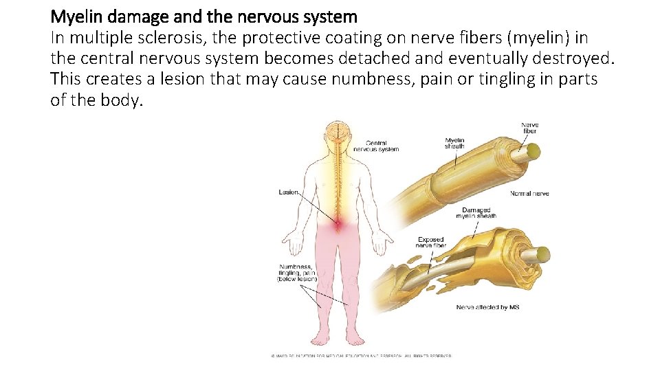 Myelin damage and the nervous system In multiple sclerosis, the protective coating on nerve