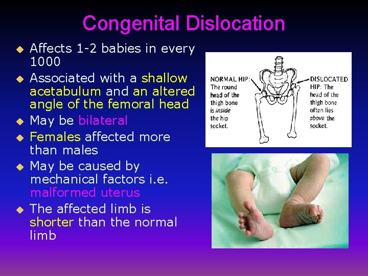 Congenital Dislocation u u u Affects 1 -2 babies in every 1000 Associated with