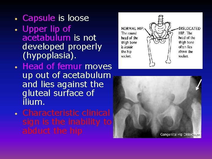  • • Capsule is loose Upper lip of acetabulum is not developed properly