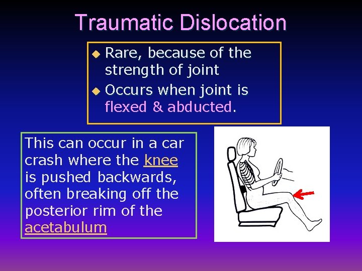 Traumatic Dislocation Rare, because of the strength of joint u Occurs when joint is