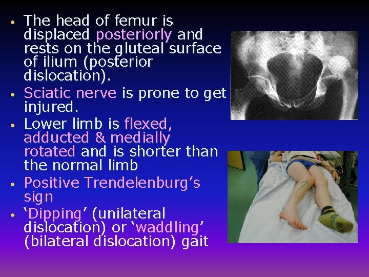  • • • The head of femur is displaced posteriorly and rests on