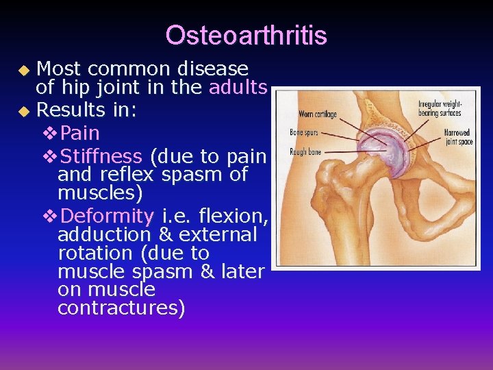 Osteoarthritis Most common disease of hip joint in the adults u Results in: v.