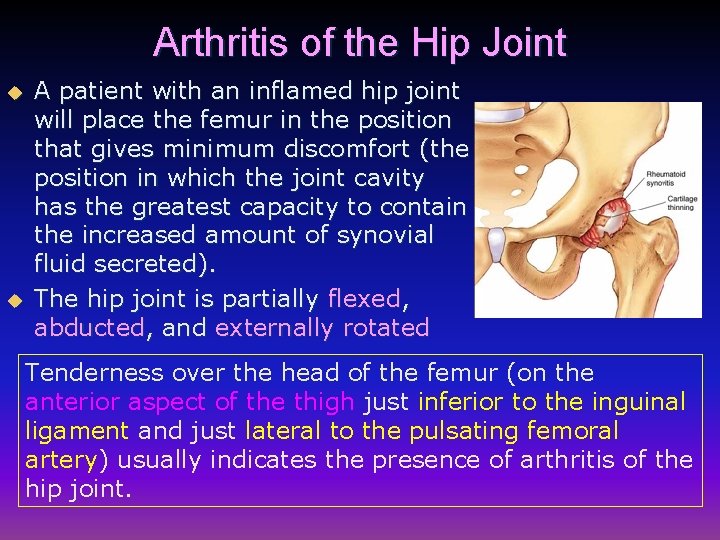 Arthritis of the Hip Joint u u A patient with an inflamed hip joint