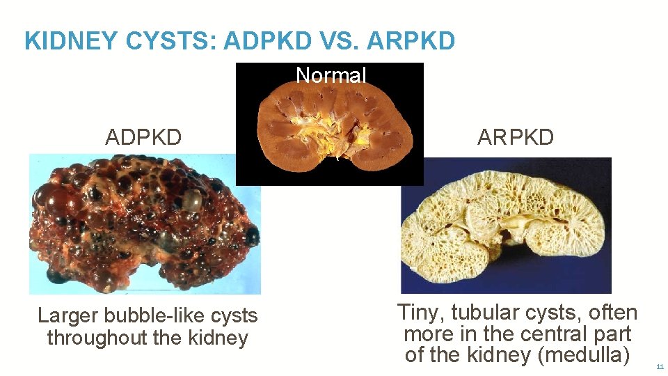 KIDNEY CYSTS: ADPKD VS. ARPKD Normal ADPKD ARPKD Larger bubble-like cysts throughout the kidney