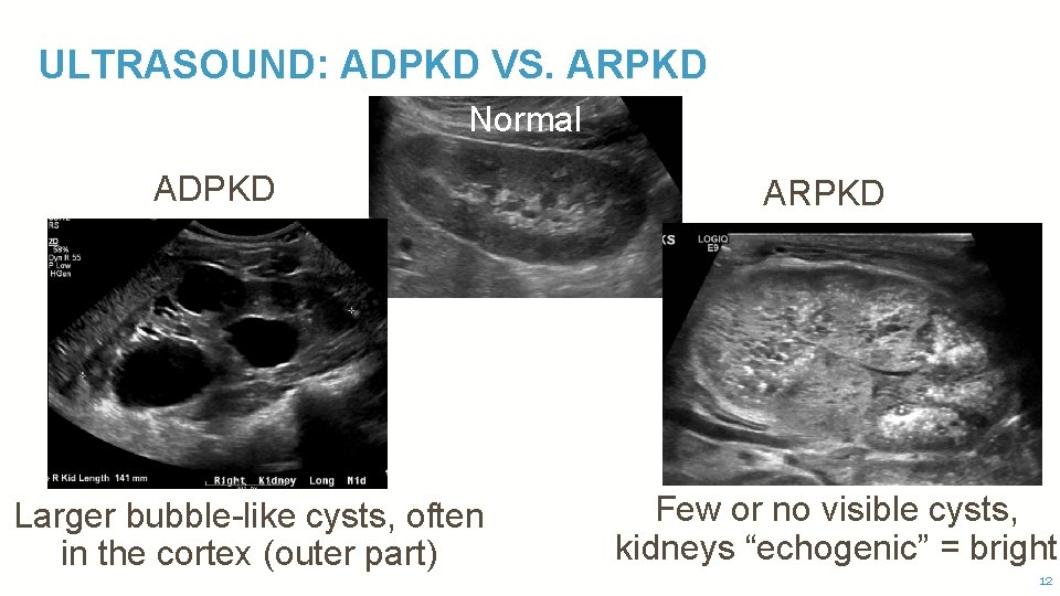 ULTRASOUND: ADPKD VS. ARPKD Normal ADPKD Larger bubble-like cysts, often in the cortex (outer