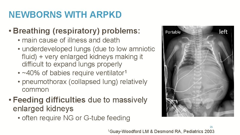 NEWBORNS WITH ARPKD • Breathing (respiratory) problems: • main cause of illness and death