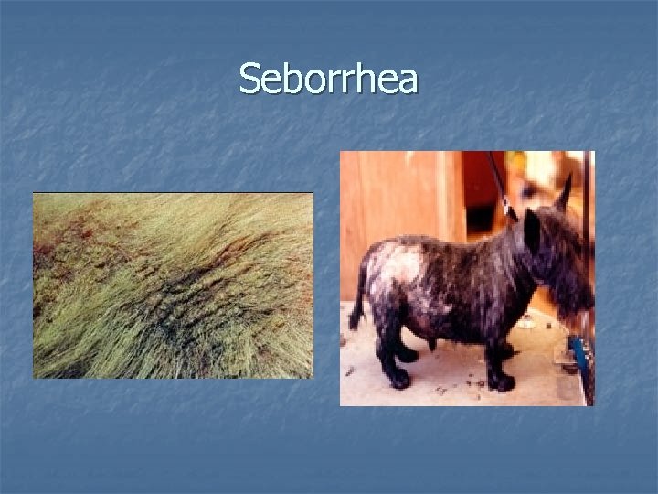 Seborrhea 