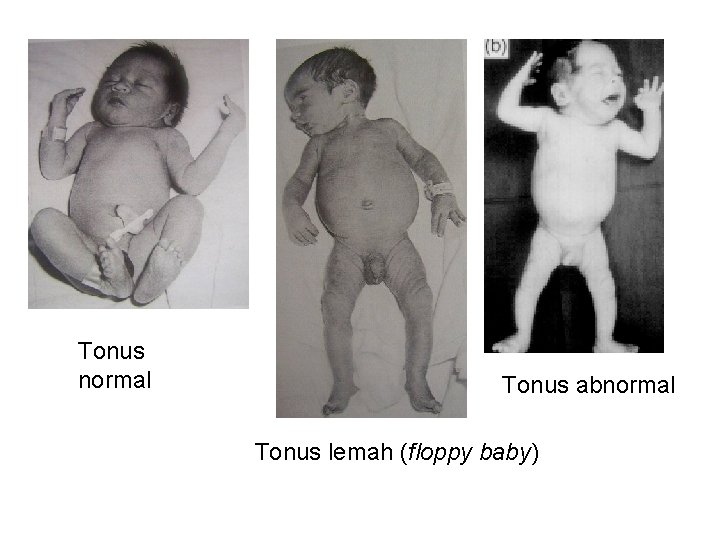 Tonus normal Tonus abnormal Tonus lemah (floppy baby) 